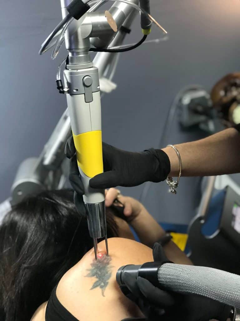 Best Tattoo Removal in Fort Lauderdale | Bad Habits Tattoos